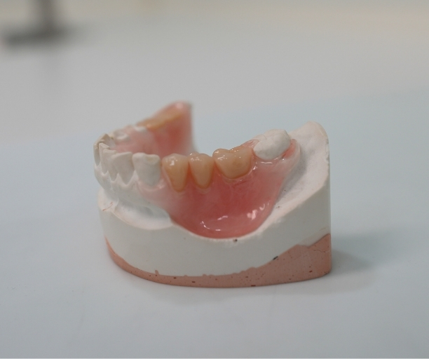 Gedeeltelijk kunstgebit